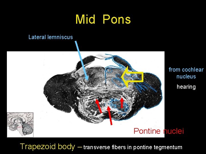 Mid Pons Lateral lemniscus from cochlear nucleus hearing Pontine nuclei Trapezoid body – transverse