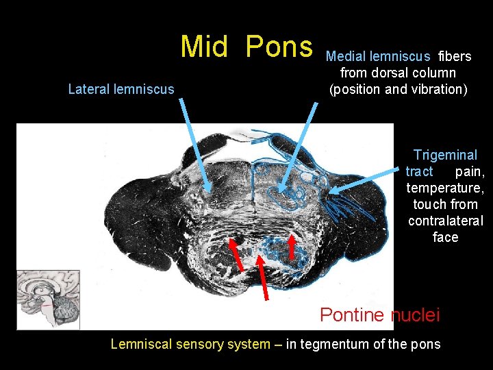 Mid Pons Lateral lemniscus Medial lemniscus fibers from dorsal column (position and vibration) Trigeminal