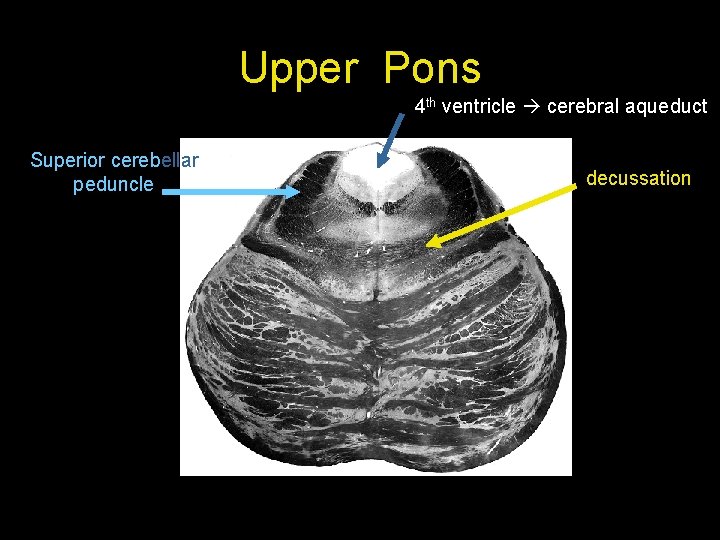 Upper Pons 4 th ventricle cerebral aqueduct Superior cerebellar peduncle decussation 