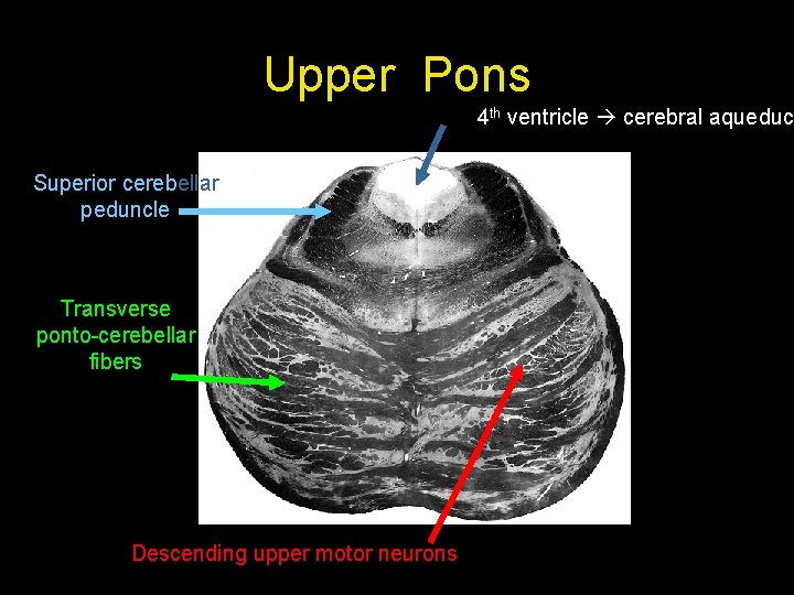 Upper Pons 4 th ventricle cerebral aqueduct Superior cerebellar peduncle Transverse ponto-cerebellar fibers Descending