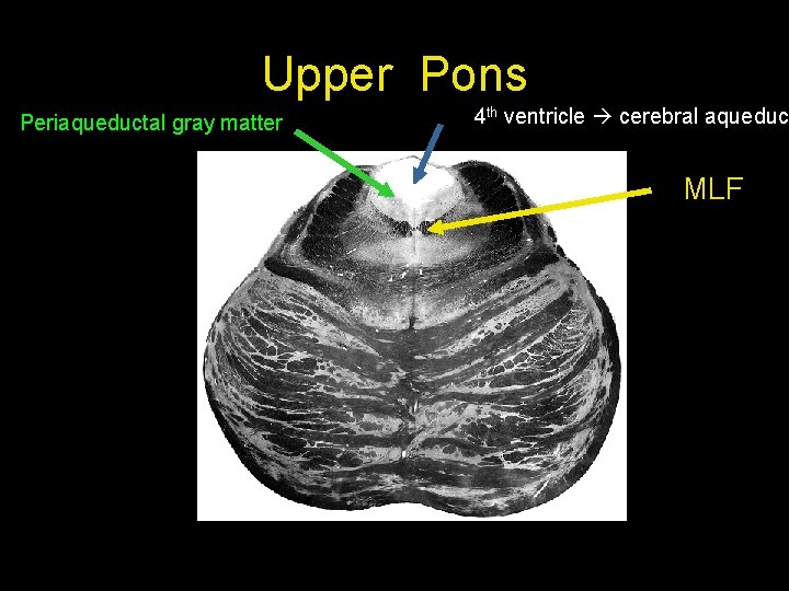 Upper Pons Periaqueductal gray matter 4 th ventricle cerebral aqueduct MLF 