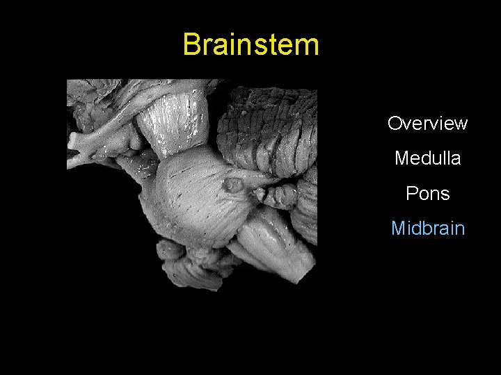 Brainstem Overview Medulla Pons Midbrain 