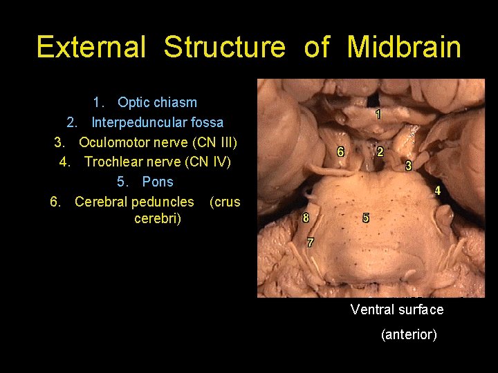 External Structure of Midbrain 1. Optic chiasm 2. Interpeduncular fossa 3. Oculomotor nerve (CN