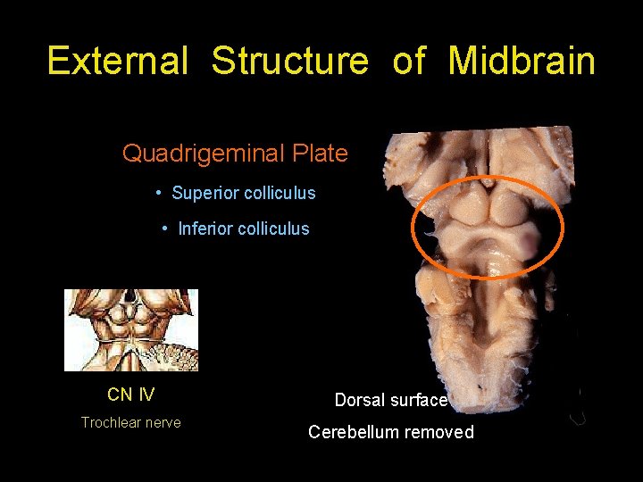 External Structure of Midbrain Quadrigeminal Plate • Superior colliculus • Inferior colliculus CN IV