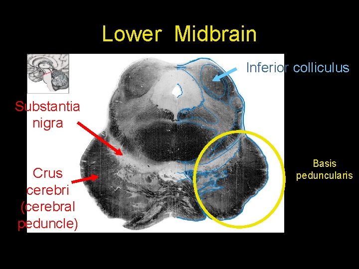 Lower Midbrain Inferior colliculus Substantia nigra Crus cerebri (cerebral peduncle) Basis peduncularis 