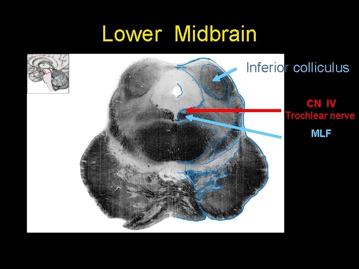 Lower Midbrain Inferior colliculus CN IV Trochlear nerve MLF 