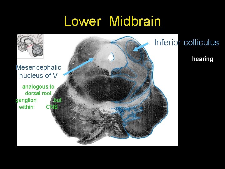 Lower Midbrain Inferior colliculus hearing Mesencephalic nucleus of V analogous to dorsal root ganglion