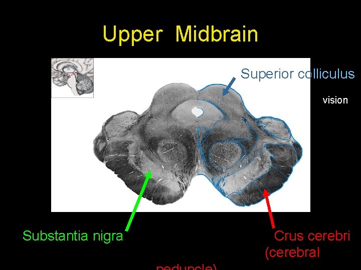 Upper Midbrain Superior colliculus vision Substantia nigra Crus cerebri (cerebral 