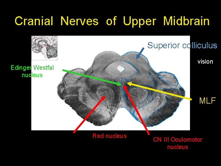Cranial Nerves of Upper Midbrain Superior colliculus vision Edinger Westfal nucleus MLF Red nucleus