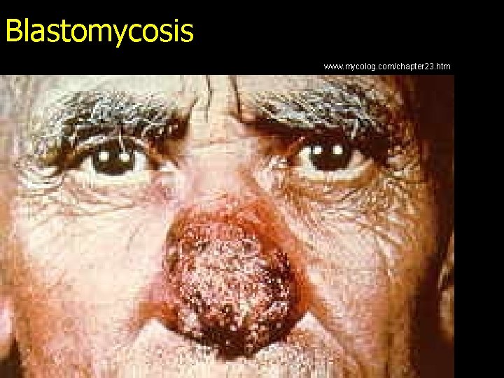 Blastomycosis www. mycolog. com/chapter 23. htm 