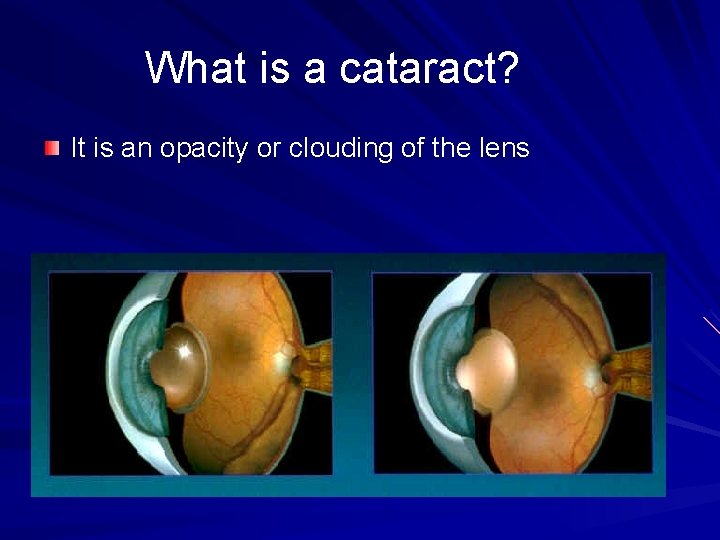 What is a cataract? It is an opacity or clouding of the lens 