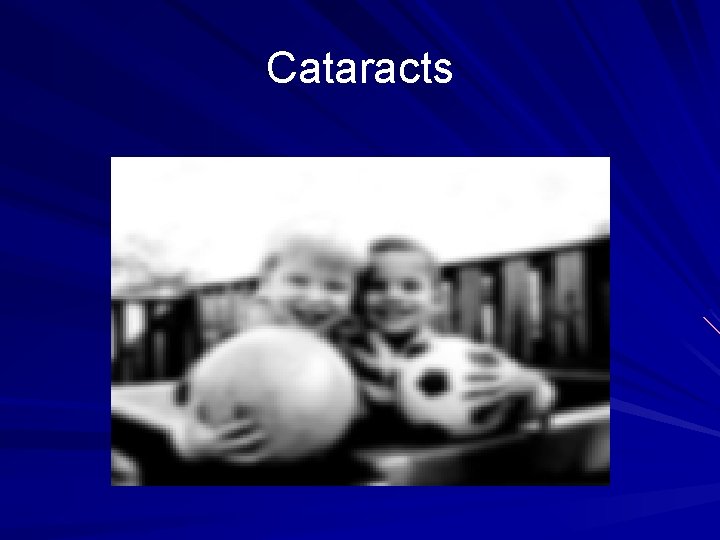 Cataracts 