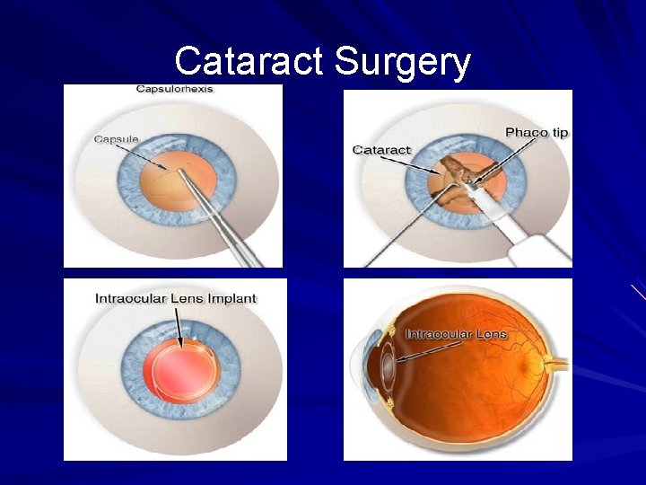 Cataract Surgery 