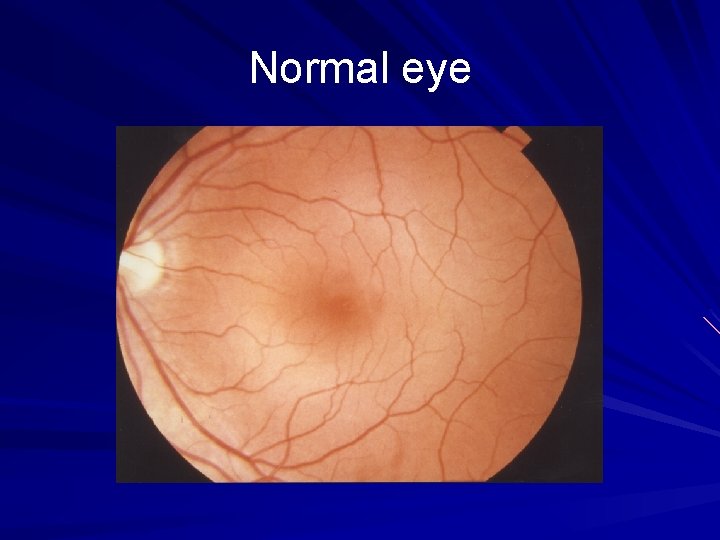 Normal eye 