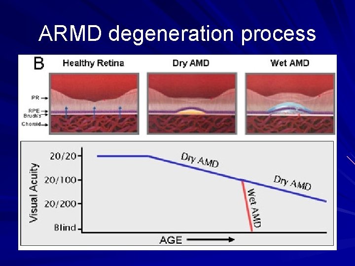 ARMD degeneration process 