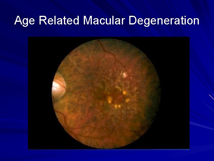 Age Related Macular Degeneration 