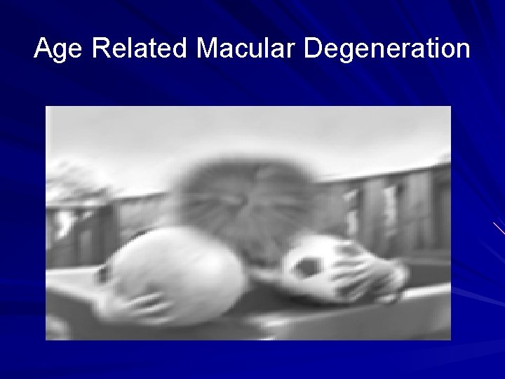 Age Related Macular Degeneration 