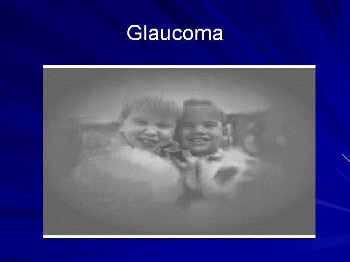 Glaucoma 