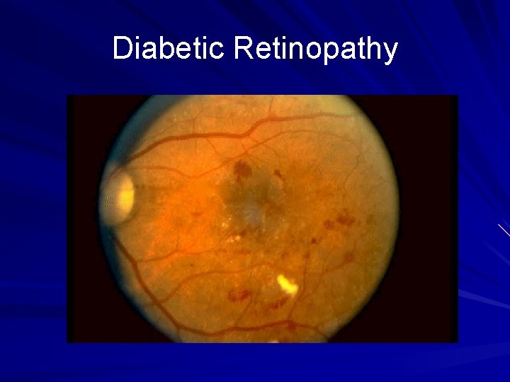 Diabetic Retinopathy 