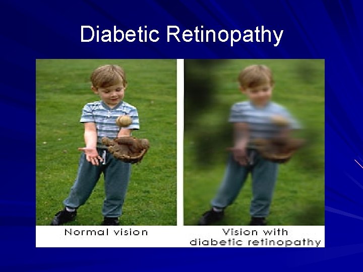 Diabetic Retinopathy 