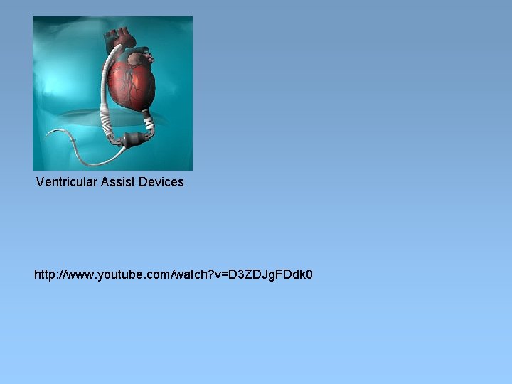 Ventricular Assist Devices http: //www. youtube. com/watch? v=D 3 ZDJg. FDdk 0 
