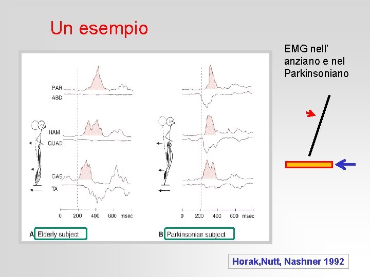 Un esempio EMG nell’ anziano e nel Parkinsoniano Horak, Nutt, Nashner 1992 