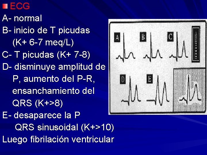 ECG A- normal B- inicio de T picudas (K+ 6 -7 meq/L) C- T