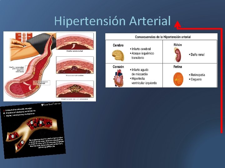 Hipertensión Arterial 