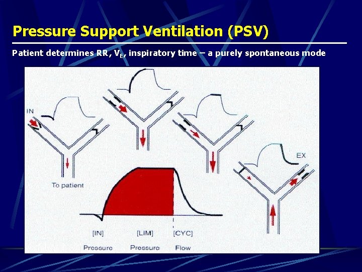 Pressure Support Ventilation (PSV) Patient determines RR, VE, inspiratory time – a purely spontaneous