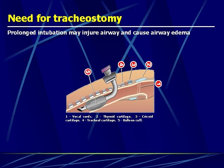 Need for tracheostomy Prolonged intubation may injure airway and cause airway edema 1 -