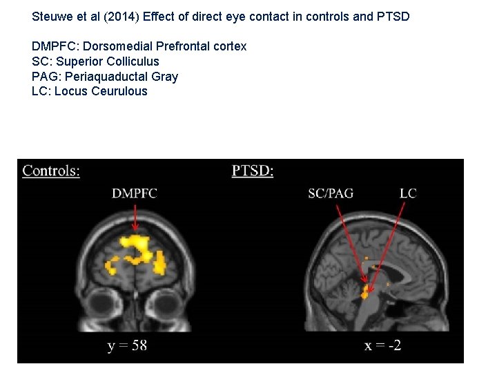 Steuwe et al (2014) Effect of direct eye contact in controls and PTSD DMPFC: