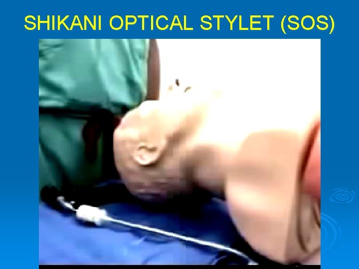 SHIKANI OPTICAL STYLET (SOS) 