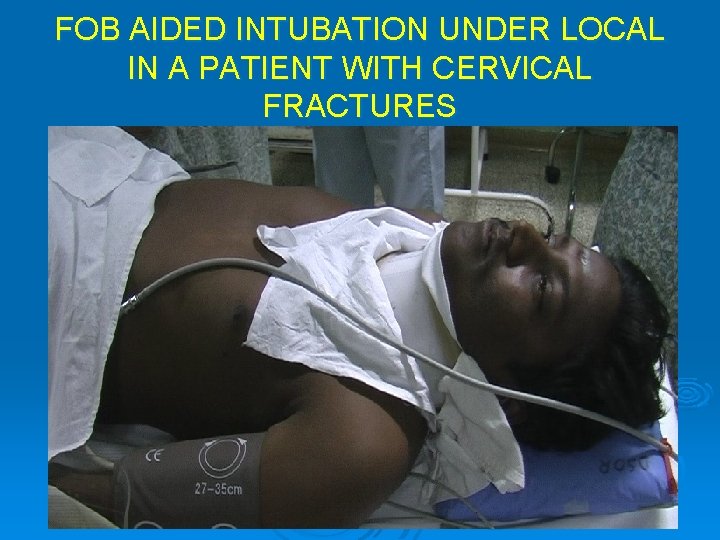 FOB AIDED INTUBATION UNDER LOCAL IN A PATIENT WITH CERVICAL FRACTURES 