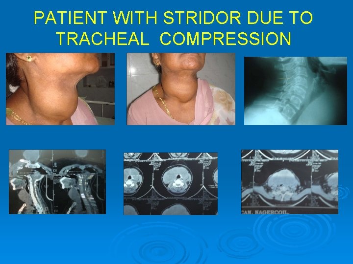 PATIENT WITH STRIDOR DUE TO TRACHEAL COMPRESSION 