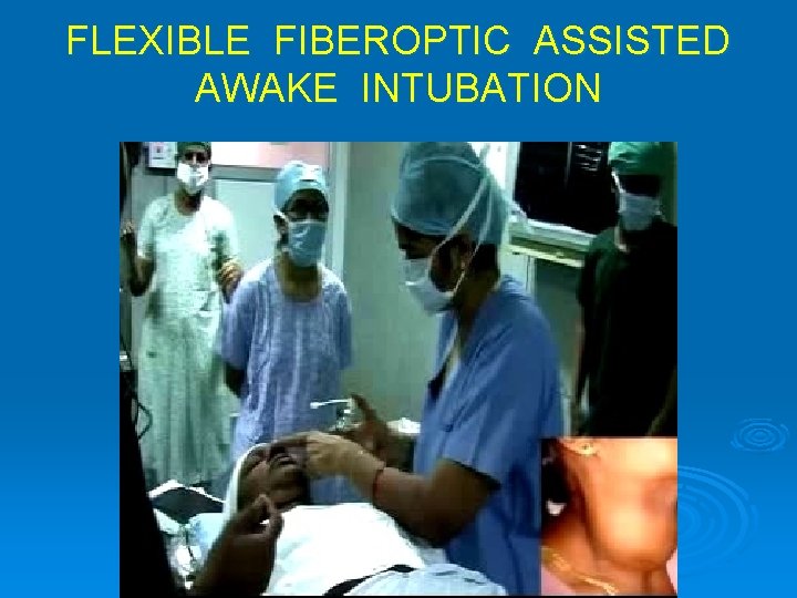 FLEXIBLE FIBEROPTIC ASSISTED AWAKE INTUBATION 