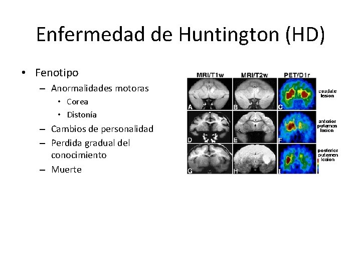 Enfermedad de Huntington (HD) • Fenotipo – Anormalidades motoras • Corea • Distonía –