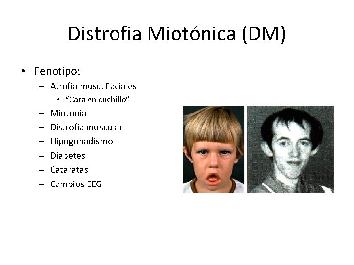 Distrofia Miotónica (DM) • Fenotipo: – Atrofia musc. Faciales • “Cara en cuchillo” –