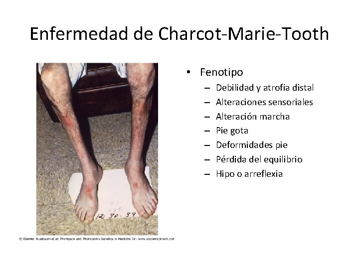 Enfermedad de Charcot-Marie-Tooth • Fenotipo – – – – Debilidad y atrofia distal Alteraciones