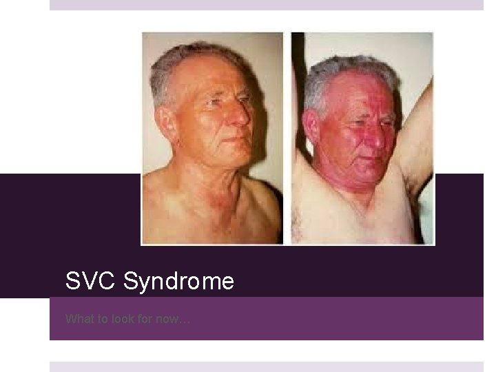 SVC Syndrome What to look for now… SVC Syndrome What to look for now…