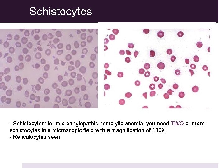 Schistocytes - Schistocytes: for microangiopathic hemolytic anemia, you need TWO or more schistocytes in