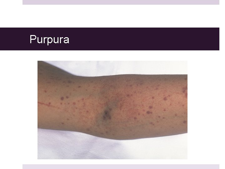 Purpura 