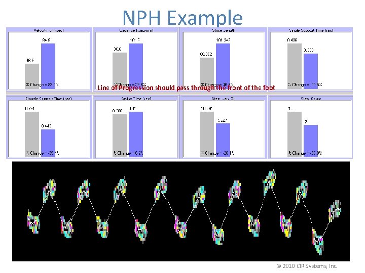 NPH Example Line of Progression should pass through the front of the foot ©