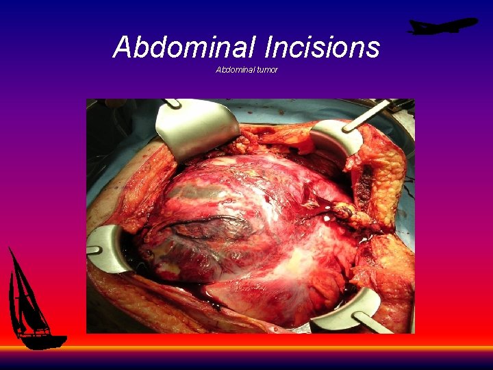 Abdominal Incisions Abdominal tumor 