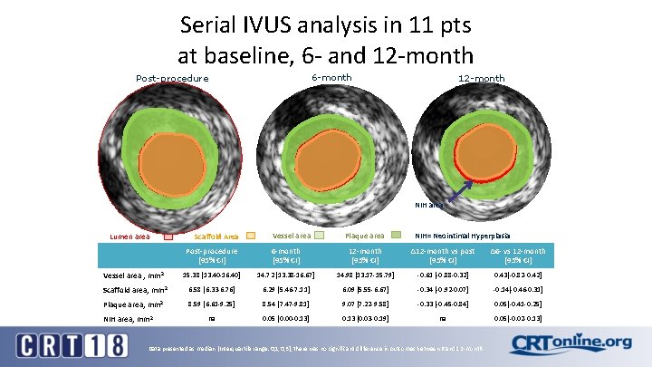 Serial IVUS analysis in 11 pts at baseline, 6 - and 12 -month 6