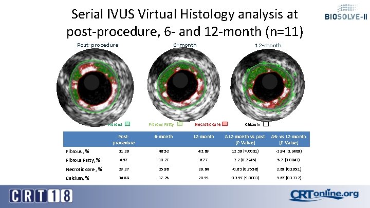 Serial IVUS Virtual Histology analysis at post-procedure, 6 - and 12 -month (n=11) 6