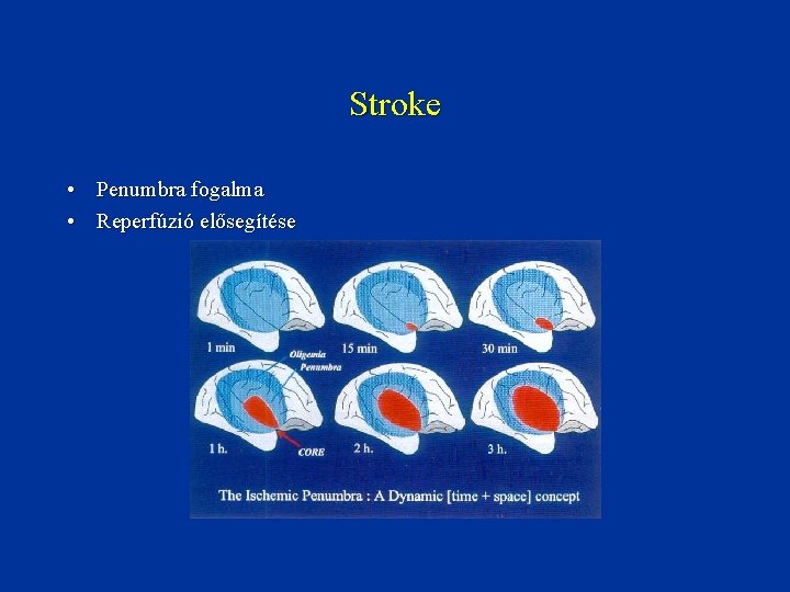 Stroke • Penumbra fogalma • Reperfúzió elősegítése 