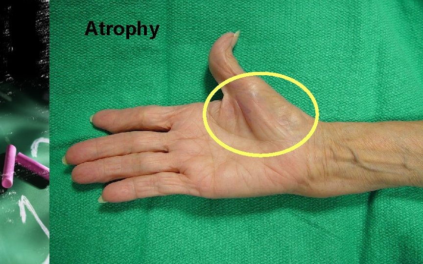 Atrophy 