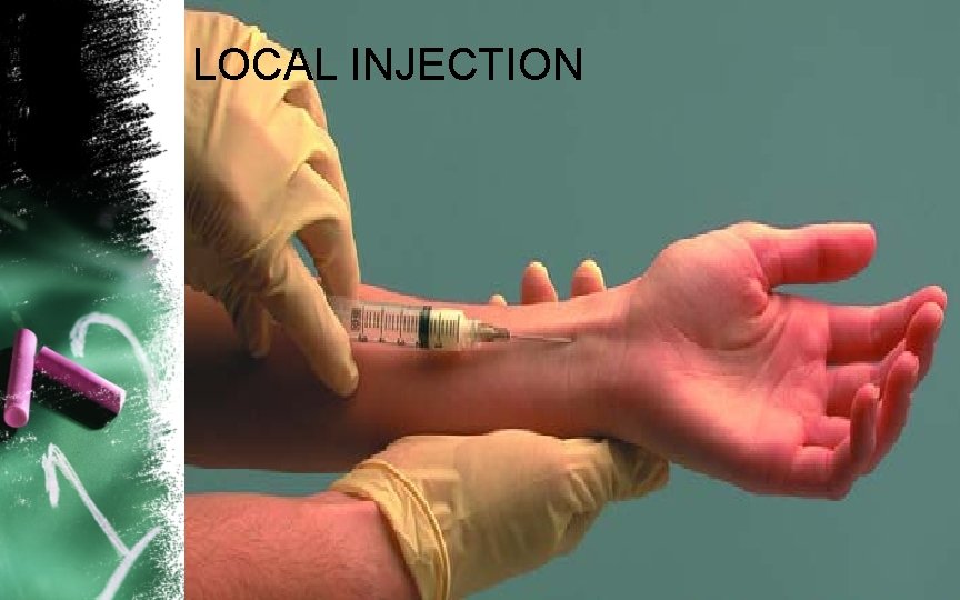 LOCAL INJECTION 
