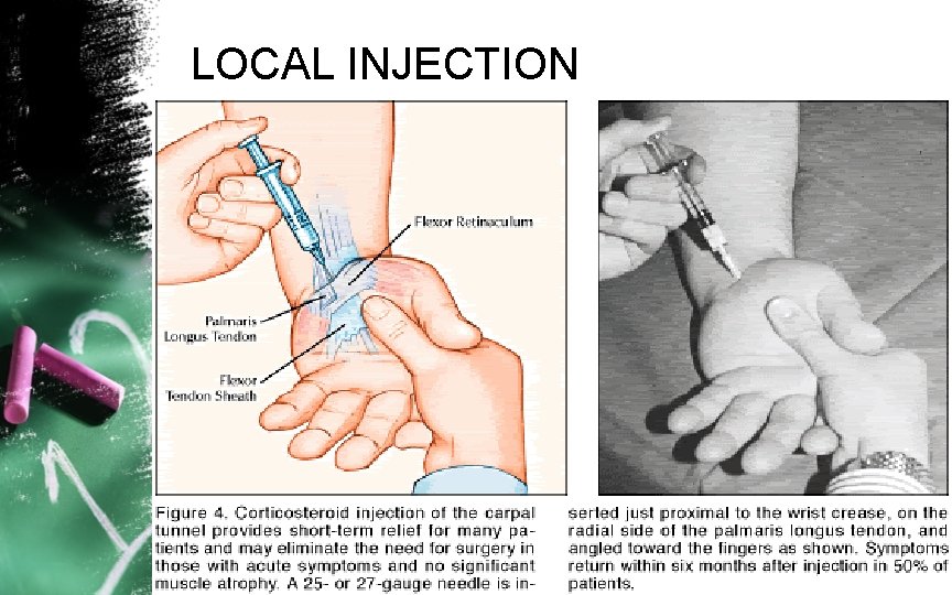 LOCAL INJECTION 