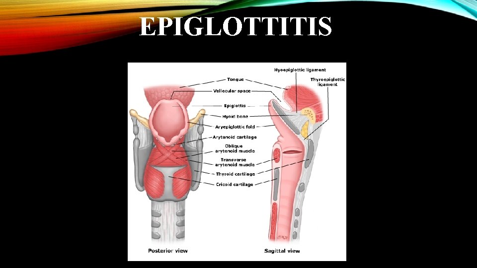 EPIGLOTTITIS 